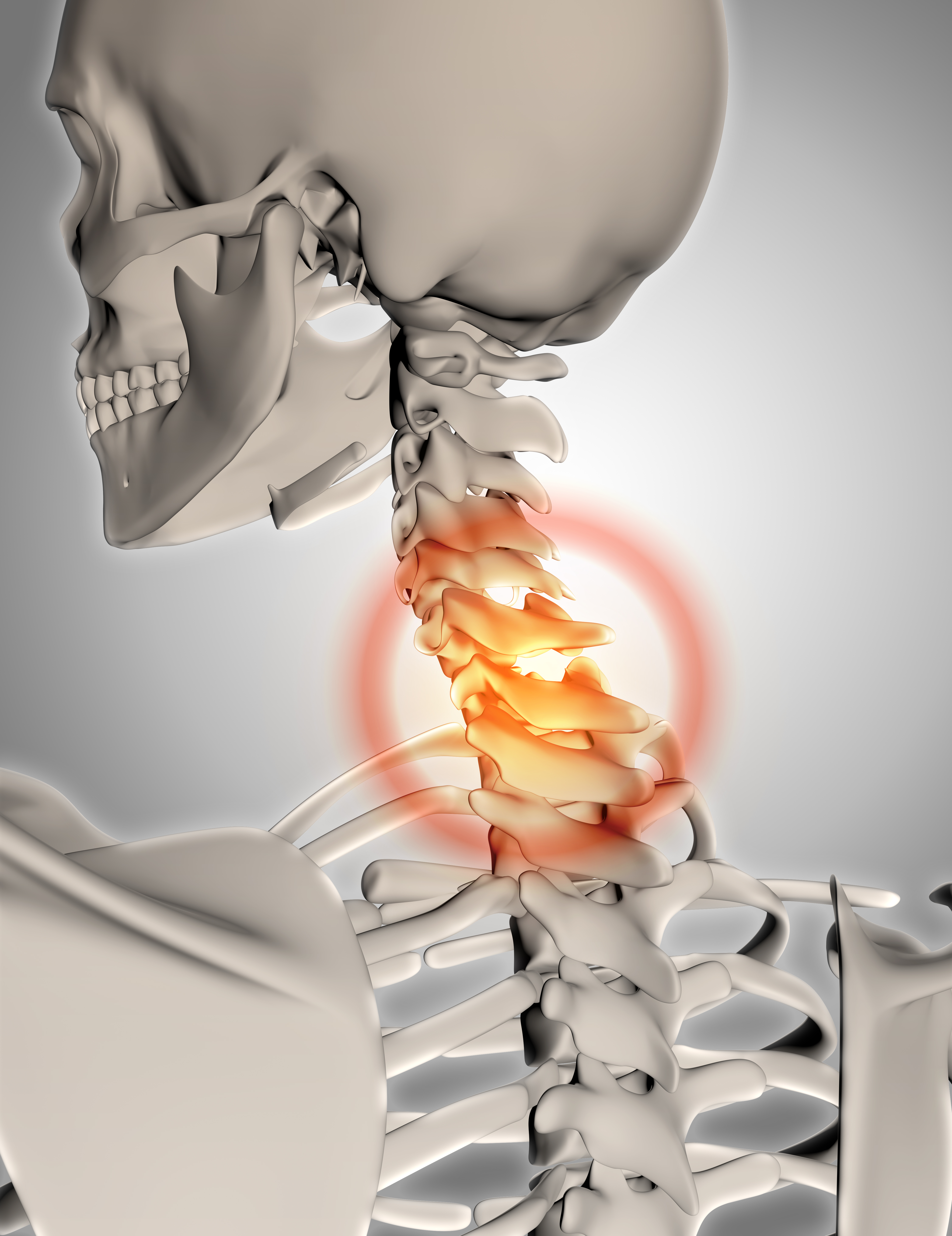 Spinal Stenosis illustration